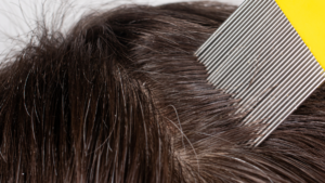 Wszy wyczesywane z włosów sposobem na nie